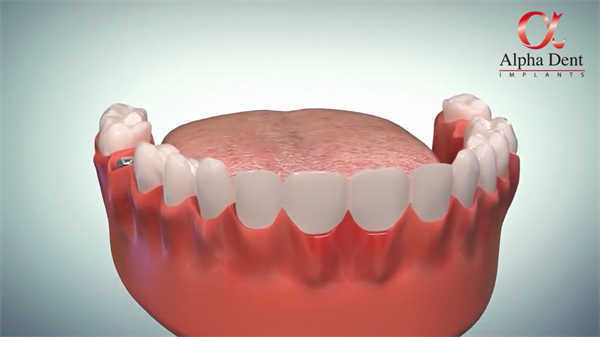 牙齒3d動(dòng)畫(huà)醫(yī)學(xué)科普知識(shí)