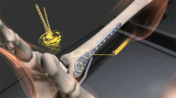 醫(yī)學(xué)骨折科普動(dòng)畫(huà)